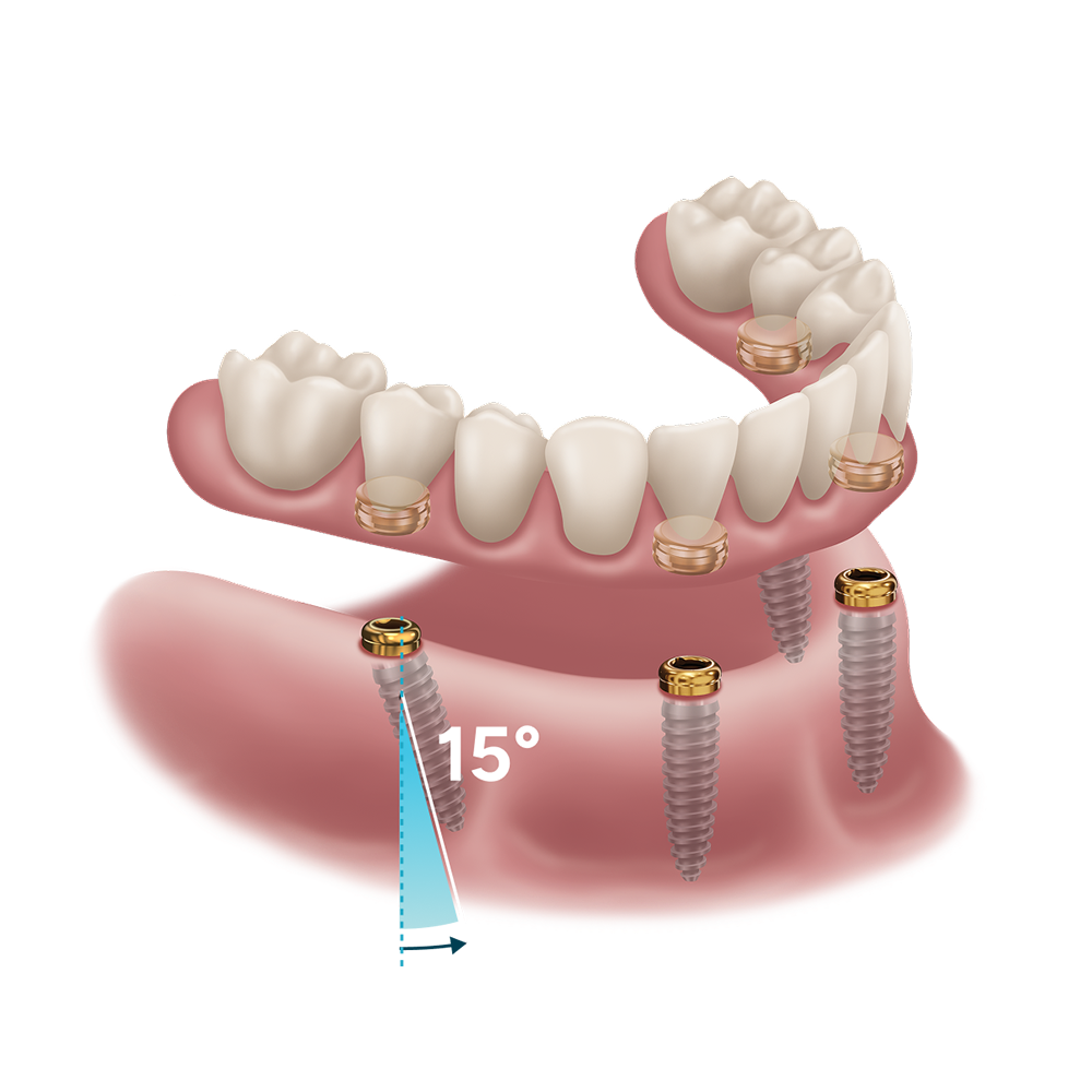 LOCATOR angled abutment system