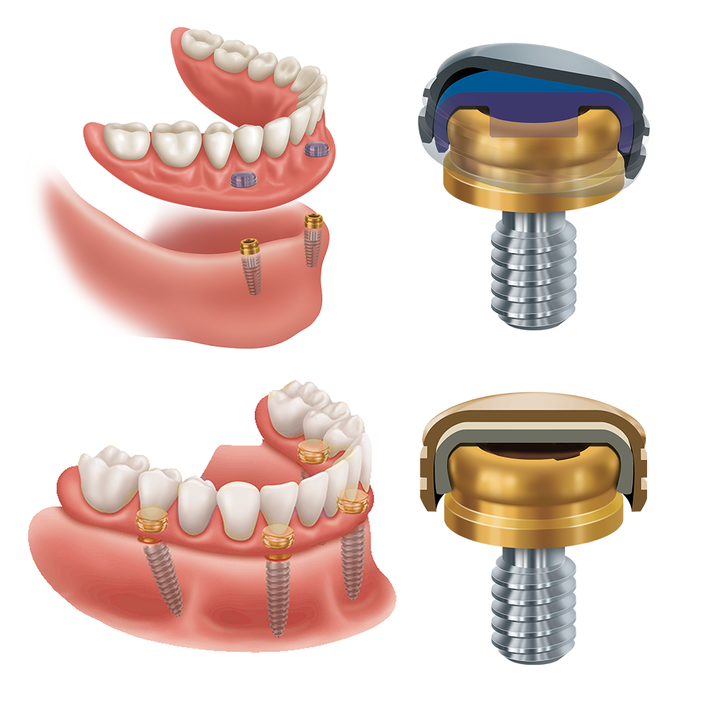 LOCATOR removable and fixed systems