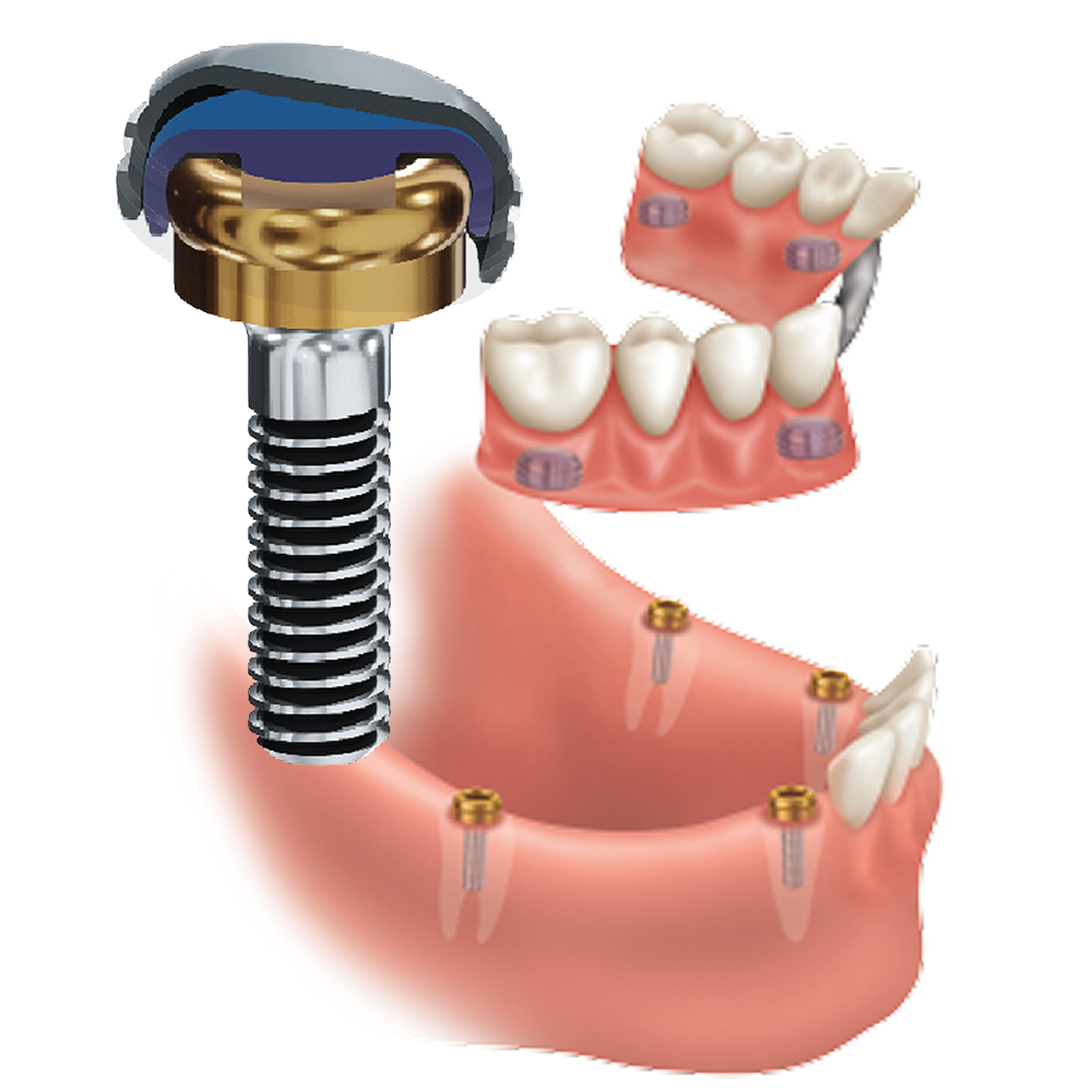 Root attachment configurations